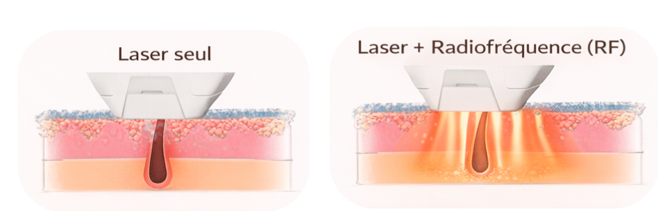 Schéma de pénétration du laser seul dans la peau