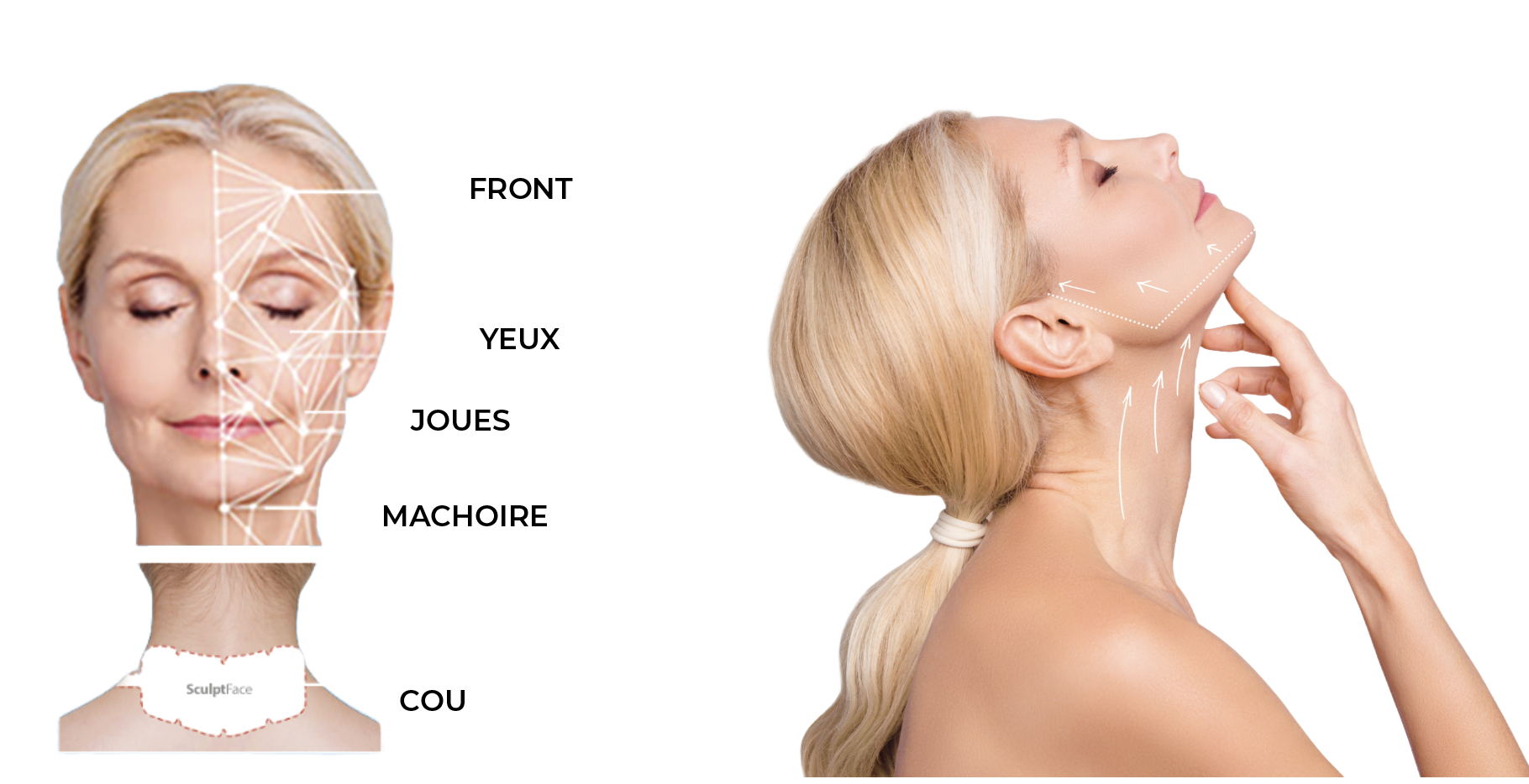 Illustration des zones de traitement